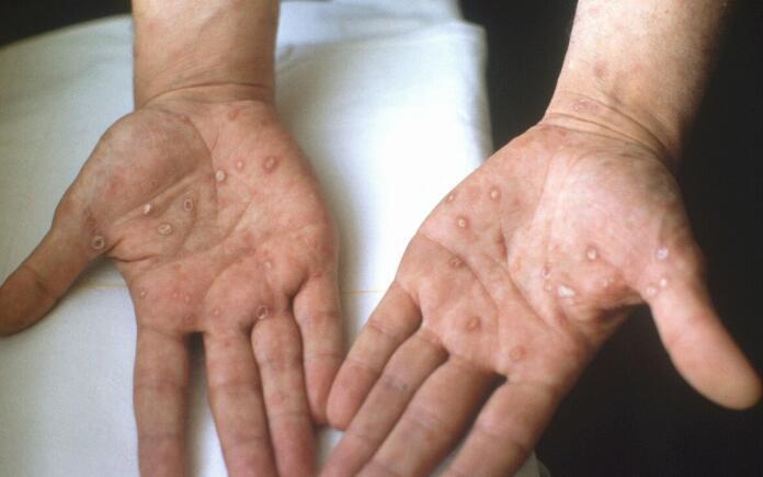 发性|小伙患上梅毒却不知情这些症状就是梅毒,有些人却不知道