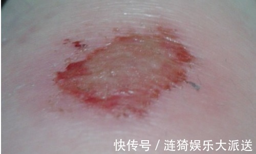 症状|当身体出现以下五种症状,多半是长寿的象征,别以为是生病!