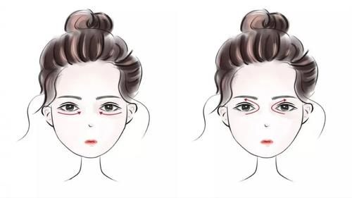 不用医美就可以解决？谁说眼袋不可逆～