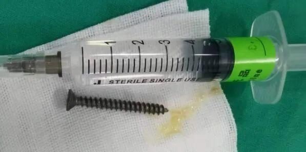 江门|惊险！江门一近两岁宝宝误吞4厘米螺丝钉！不幸中的万幸是……