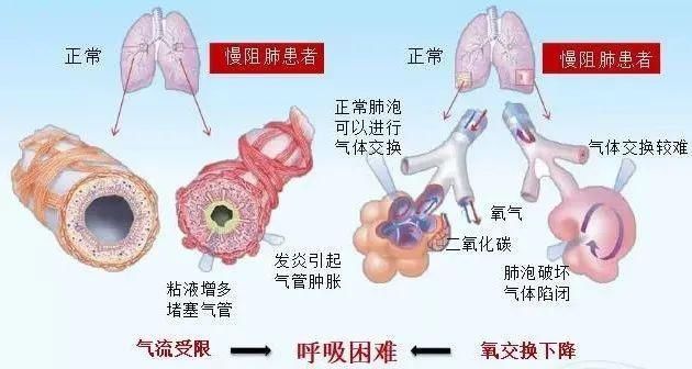 共抗慢阻肺|疾控话健康| 吸烟者