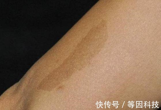 小乐|胎记长在哪里最有福气恕我直言,2种胎记长哪都可能是祸根