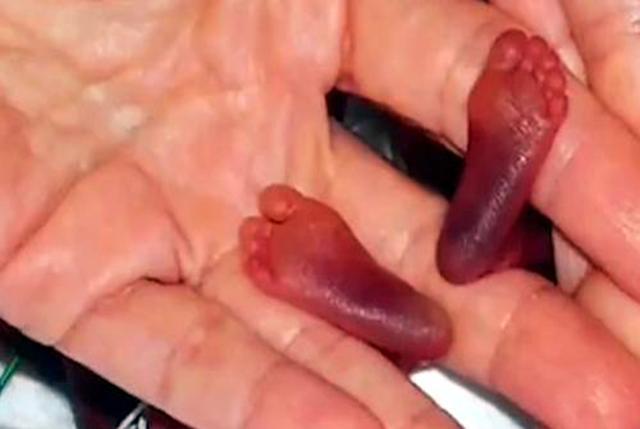 准妈妈|14年过去,原本身体巴掌大“世界最小宝宝”,如今颜值高到认不出