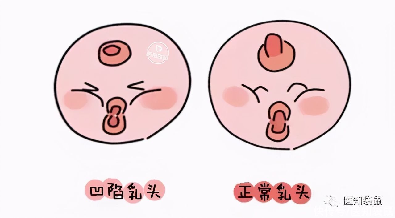 手术治疗|娃还没生出来，就开始分泌乳汁了，这正常吗？