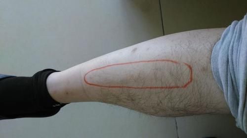 腿部|血脂高不高，”小腿“先知？医生：血脂偏高，身体或有这几个表现