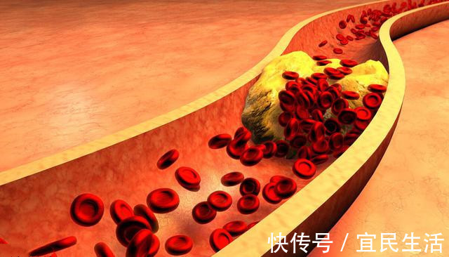 斑块|天凉了!心梗脑梗猝死多了!医生提醒这样预防心梗脑梗和猝死!