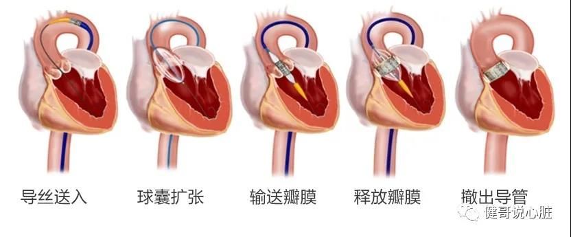 二尖瓣|【健哥说心脏】给心脏修阀门——经导管主动脉瓣置换术
