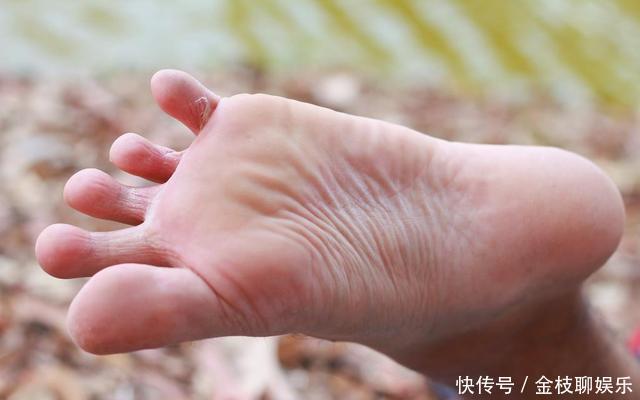 长脚气是什么原因如何治疗和预防复发,一文为你全总结