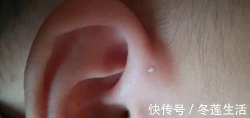 宝妈|宝宝耳朵有“聪明孔”,妈妈忍不住挤了一下,医生摇头动手术吧