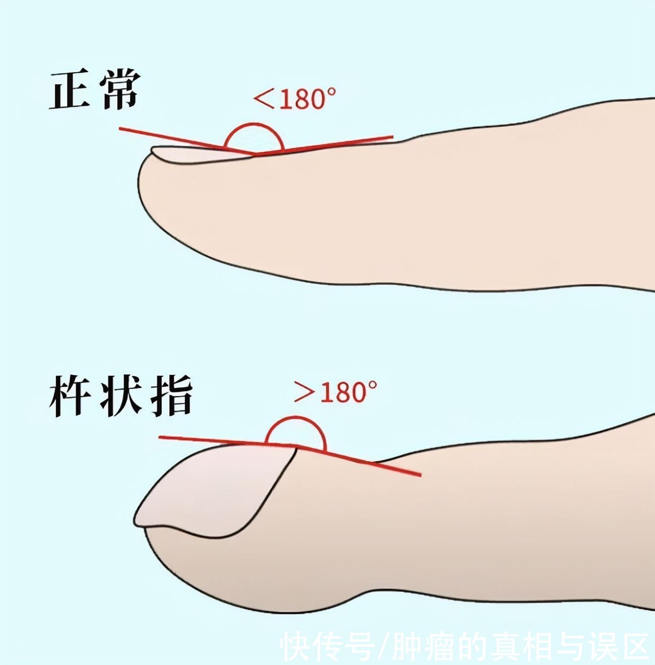 银屑病|从手指也能看出肺癌？提醒：手指出现5个异常，赶紧排查病因