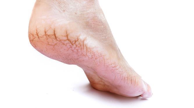 皮肤干燥|脚后跟干裂怎么也治不好找对病因才见效,2个因素你属于哪种