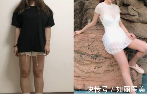 大长腿 大腿吸脂的价格多少钱？内附术后对比图日记~