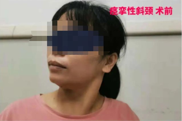 女子|以为是落枕？女子歪脖子6年，没想到竟是这个原因