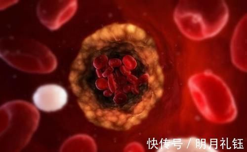 阴陵泉穴|穴位妙用,常按5个穴位,解决高血脂,远离心脑血管疾病