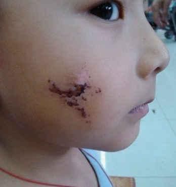 妈妈|4年前因吃奶太用力,被妈妈用剪刀划伤脸的男婴,现状惹人感慨