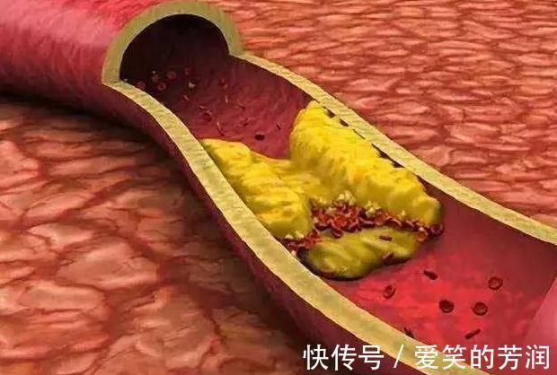 脑卒中|颈动脉斑块是否能逆转?医生道出4个注意事项,不妨收藏下!