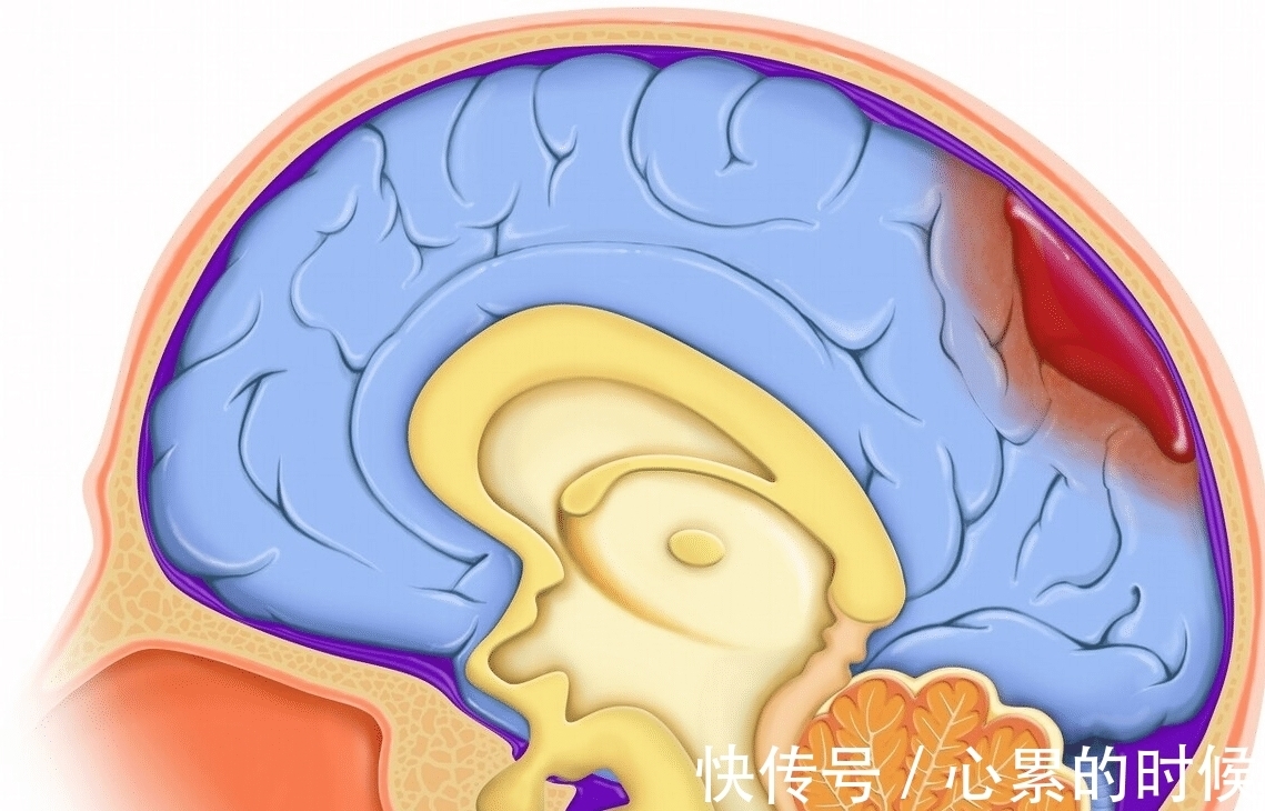 颈动脉狭窄|人到中年，不想中风，做好以下6点，让你活得更健康