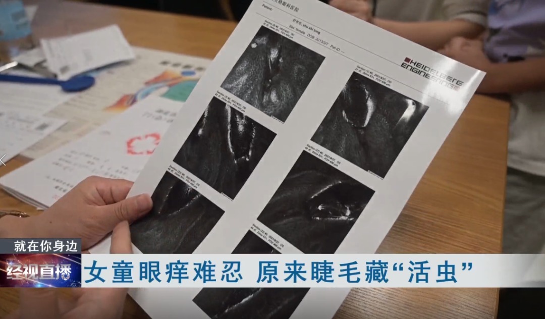 拔掉|眼睛奇痒,10岁女孩拔光睫毛,元凶竟是它