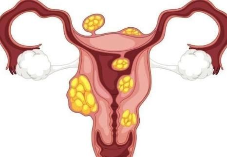 子宫肿瘤|子宫肌瘤要不要做手术?符合此3种情况最好做手术,万万不要拖