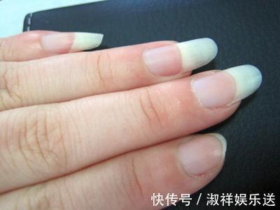 青筋|血管好不好,手不会骗你!若手上出现此3“异象”,该养血管了