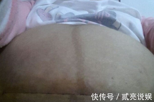 晓丽|女子剖腹产三个月伤口冒水,医生检查伤口,不淡定