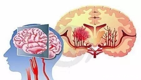  发生|脑血管崩溃前有10个信号！