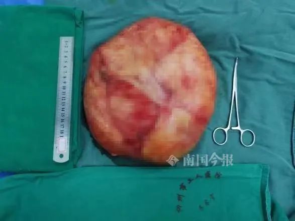 脏器|柳州这81岁阿婆腹围不断增大，以为是“发福”！没想到 ...
