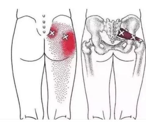 臀部|梨状肌综合征：导致臀部疼痛的罪魁祸首！