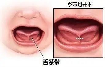 动手|4岁了还说话不清？别急，这种情况才需要动手处理！