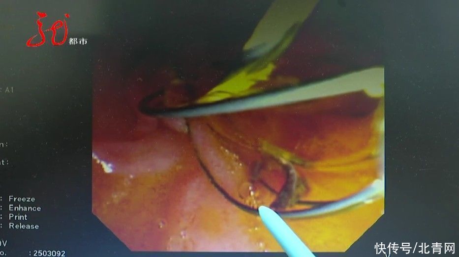 寄生虫|肚子里一天流出十多只虫子,就因为他吃了这种鱼……