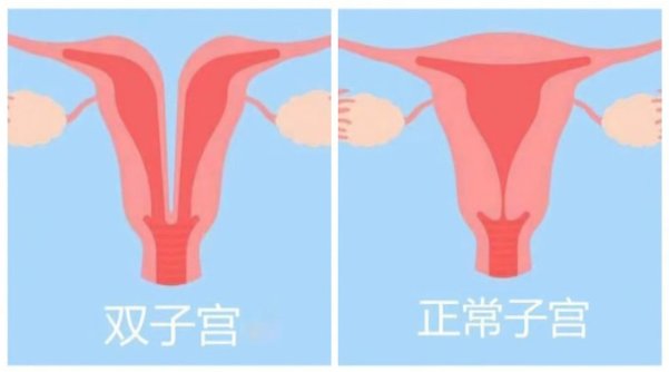 女子|25岁女子体内竟有2个子宫，怀孕后医生说…