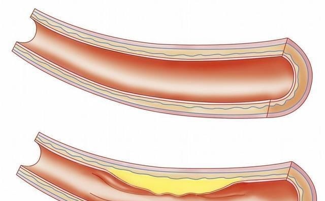 压强|“降压高手”已公布,不是洋葱木耳,每天掺水喝,血压悄悄正常了