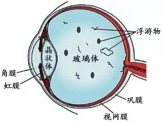  眼前|飞蚊症不需要治疗，是真的吗？专家：没那么简单！