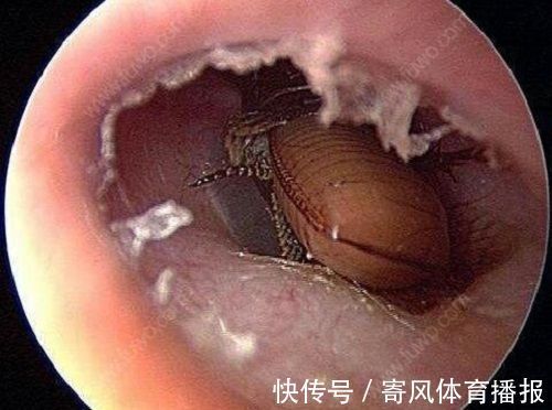 耳道|6岁女孩耳朵半夜进虫子,奶奶接下来的操作,医生都连连称赞!