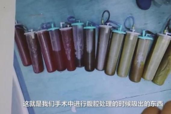 男子饭后肚子发生爆炸,医生从其腹腔吸出3000毫升粪水