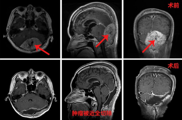 张宏伟|分站式复合手术切除鹅蛋般大小脑转移瘤 肾癌脑转移瘤患者蝶变重生