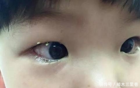 孩子|5岁宝宝眼睛“看不见了”,家人以为没睡好,检查后医生来晚了