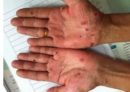 先知|肝不好，“手”先知，双手出现3种症状，或是肝脏“求援”早预防