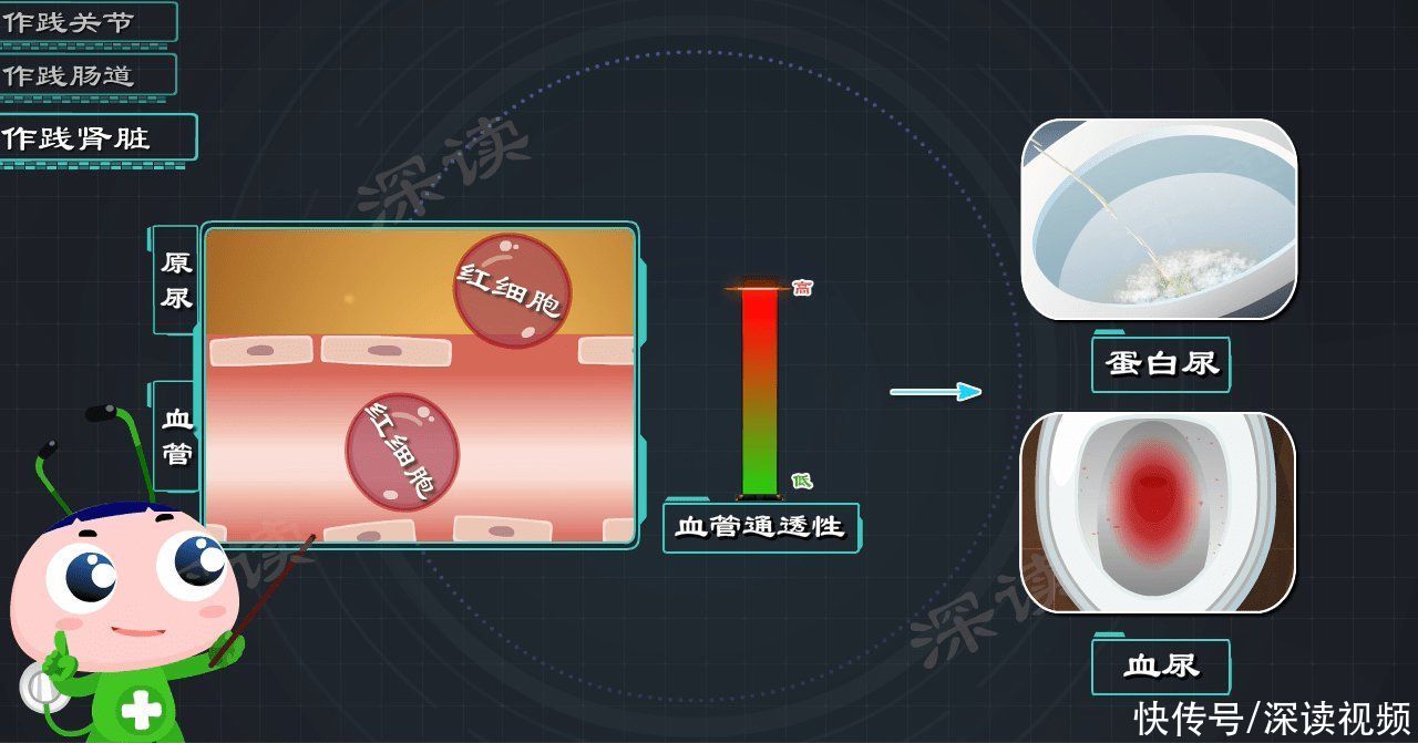 通透性|从腿上小红疹到血尿、蛋白尿，过敏性紫癜是咋搞出肾损伤的？