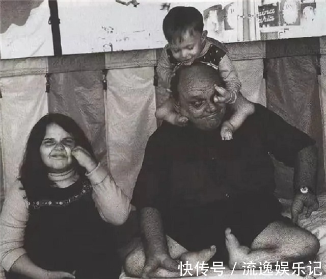 畸形#可恨又可悲的“龙虾手男孩”:畸形跟了他一生,最后死在妻子手里