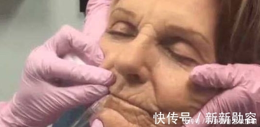 美美|80岁奶奶打玻尿酸,仿佛年轻了40岁:老了也要美美的