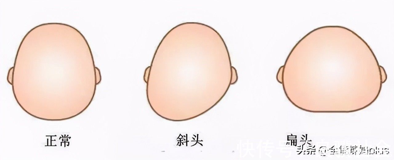 圆头|“妈求求你,别给我睡扁头了”扁头有多毁娃?3张对比图告诉你