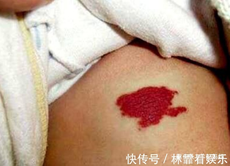 蝙蝠侠|越来越多胎儿被“胎记”缠身,若不想孩子自卑,孕妈要管住自己