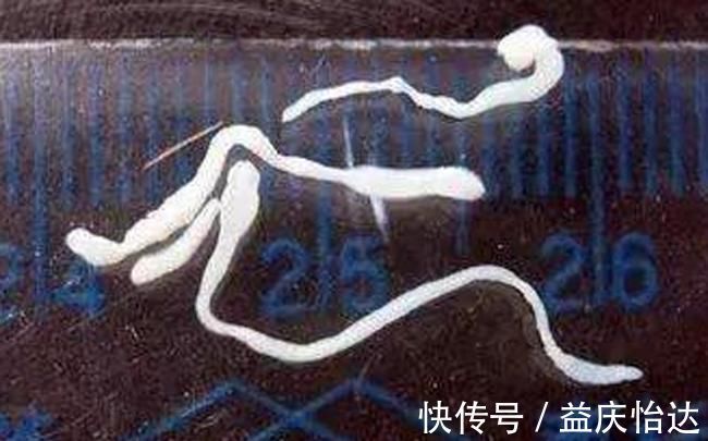 寄生虫|7岁小孩大脑取出8厘米寄生虫,医生怒骂:孩子妈怎么能如此无知