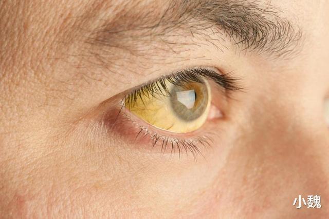 列入|世卫组织3种蔬菜已被列入伤肝“黑名单”,提醒父母,尽量少吃