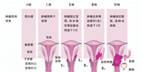 诊断|22岁女大学生被诊断出宫颈癌,哭求4个男朋友该为其“埋单”