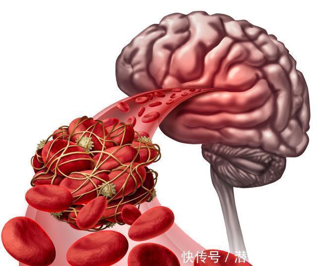 病人|为什么中国脑梗病人多?医生感慨:和肥肉无关,厨房这一物是祸首