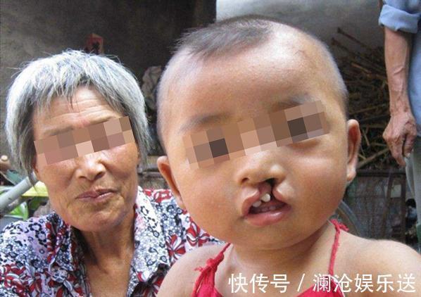 胎儿|医生三类孕妇容易生“兔唇”宝宝,如果你在其中,就要小心了