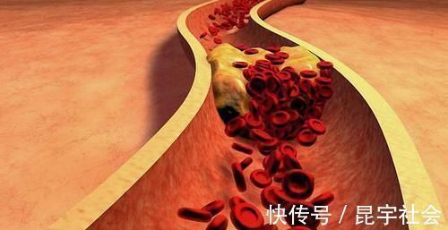 冠心病|高血脂“害怕”3件事,你若能坚持,血管一天比一天干净!
