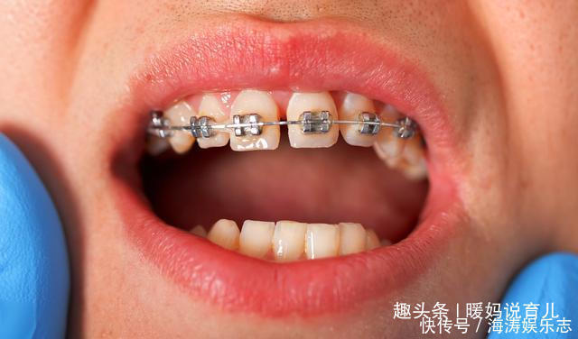 习惯|常见的习惯导致孩子兜齿,详谈兜齿形成的原因及早期的预防